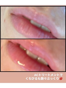 エンチャント(ENCHANT+)/エステ版水光注射療法！？