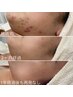 【ニキビケア卒業×再発防止】剥離なし「 最後の砦 」肌質改善  初回¥15,000