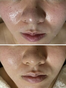 マリエンドリー/毛穴の汚れ　黒ずみ