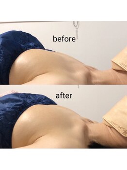 ミリミリ(mili mili)/バスト施術