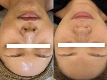 ミルジュ(MiLuJu)/ACトリートメント2回ビフォアフ