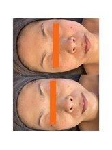 カウニス るる(kaunis)/【ララピール】Before After