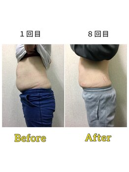 マリモ鍼灸接骨院/電磁パルス　週1回8回目