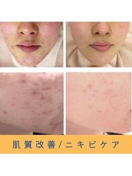 いつつのき/美容鍼