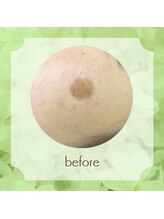 ビューティフィーサロン ベルル(Belulu)/シミケアビフォー