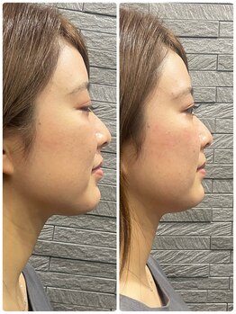 長寿鍼灸院 長寿整骨院/ハリネズミ女優美容鍼効果★