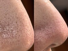 エミナル(Eminal)/◆毛穴フルコース　1回