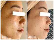 ポモナ 横浜馬車道店(Pomona)/こまかいシミに長年お悩み