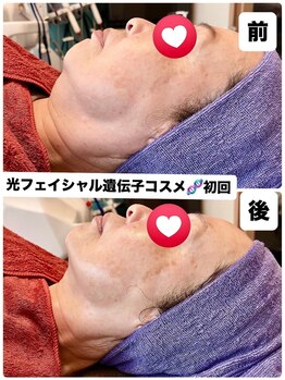 ローズ 下松(ROSE)/アゴ下のたるみケアが気になる