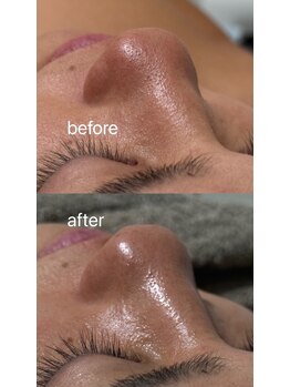 リル(LIL by lum)/名古屋/毛穴洗浄/セラピール