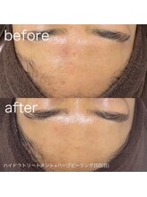 ルルラ リコ(lulula rico)/症例写真/ハーブピーリング