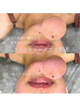 ナナイロサロン フクオカ(NaNairoサロン Fukuoka)/ フェイシャルワックス＋光脱毛 