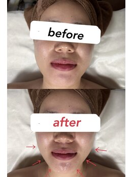 アイラン(AiRan)の写真/気になるほうれい線・たるみに！お手頃価格で施術直後から引き締まった若見え肌へ