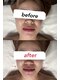 アイラン(AiRan)の写真/気になるほうれい線・たるみに！お手頃価格で施術直後から引き締まった若見え肌へ