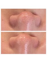 シェリモ(CHERIMO)/スーパーフードワックス1回