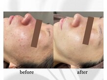 アン ビューティー(ann beauty)の雰囲気（【男女】結果重視！光フェイシャル 毛穴コース  初回→6回目）