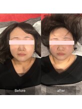 プライミー(PRIMY)/フェイスラインチェンジ