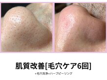 シェリール(Cherir)/肌質改善