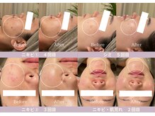 ルプレ(Lupure)の雰囲気（お肌のお悩みを徹底改善◎剥離なしハーブピーリング×植物幹細胞）