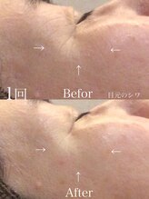 ボディベルム(BODY BELM)/コラーゲンケアで目元のハリUP