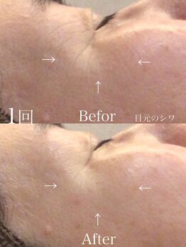 ボディベルム(BODY BELM)/コラーゲンケアで目元のハリUP