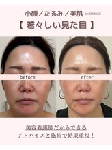 タルボ(TALBO)/小顔が叶う