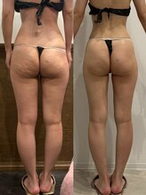 パリスヒロトン(PARIS HIROTON)/痩身症例写真(20代)