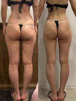 パリスヒロトン(PARIS HIROTON)/痩身症例写真(20代)