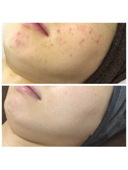 リラーナ(Re rana)/大人ニキビケア♪