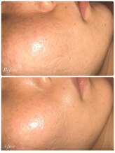 シャナ(Shana)/マリムーブフェイシャルWAX