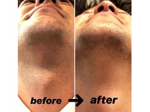 ボス 岐阜店(BOSS)/【ヒゲ脱毛】※3回施術後　#脱毛