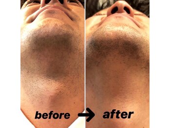 ボス 岐阜店(BOSS)/【ヒゲ脱毛】※3回施術後　#脱毛