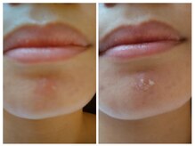 ル リアン(soins de visage Le lien)/水素パックの実力！！