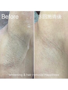ハピネス 広島並木通り店(Happiness)/ワキ脱毛Before→After