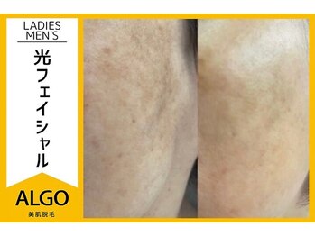 アルゴ 越前店(ALGO)/光フェイシャル