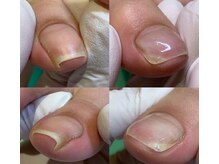 巻き爪補正店 和 光市店の雰囲気（巻き爪施術のビフォーアフター。巻き爪/巻き爪ケア/巻き爪矯正）