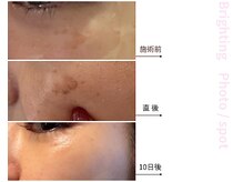 ドアディ(Doordie)/Brightingフォト　しみケア 