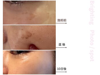 ドアディ(Doordie)/Brightingフォト　しみケア 