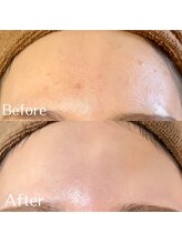 バーニー 梅田店(BARNEY)/ハーブピーリング