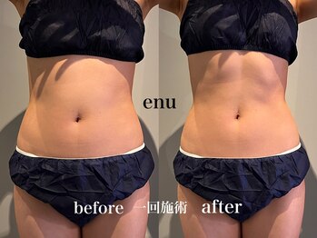 エヌ 白金台(enu)/おなかスッキリ