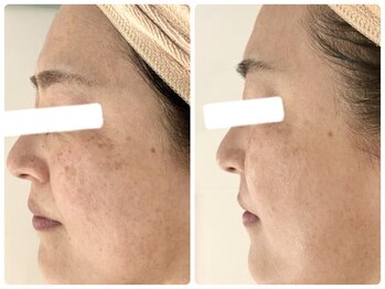 ポモナ 横浜馬車道店(Pomona)/シミケア・シミ改善美肌ケア