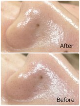 ハクミー(haku me)/☆毛穴汚れ黒ずみケア☆