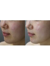 エイジングケア専門サロン サンク(thanq)/ヒト幹細胞エステで透明感爆発！