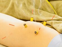 一二三鍼灸マッサージ治療院/【膝の辛さには囲み灸・鍼】