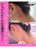 セットメニュー☆【うなじ&背中上脱毛】￥9000→￥8000◎期間限定