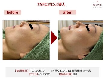 ブリエ/美容皮膚科監修エステ美顔導入器