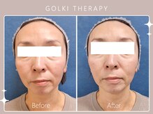 シロカネ イオンタウン西熊本店(SHIROKANE)/韓国式小顔コルギ☆