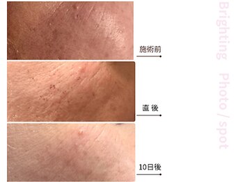 ドアディ(Doordie)/Brightingフォト　しみケア 