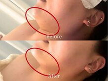 アストリエ グレース 相模大野(Astorie Grace)/脂肪分解効果でスッキリ