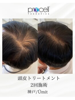 ユミト(Umit)/プロセルスカルプ